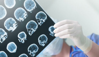 epileptic brain scan neuroservice